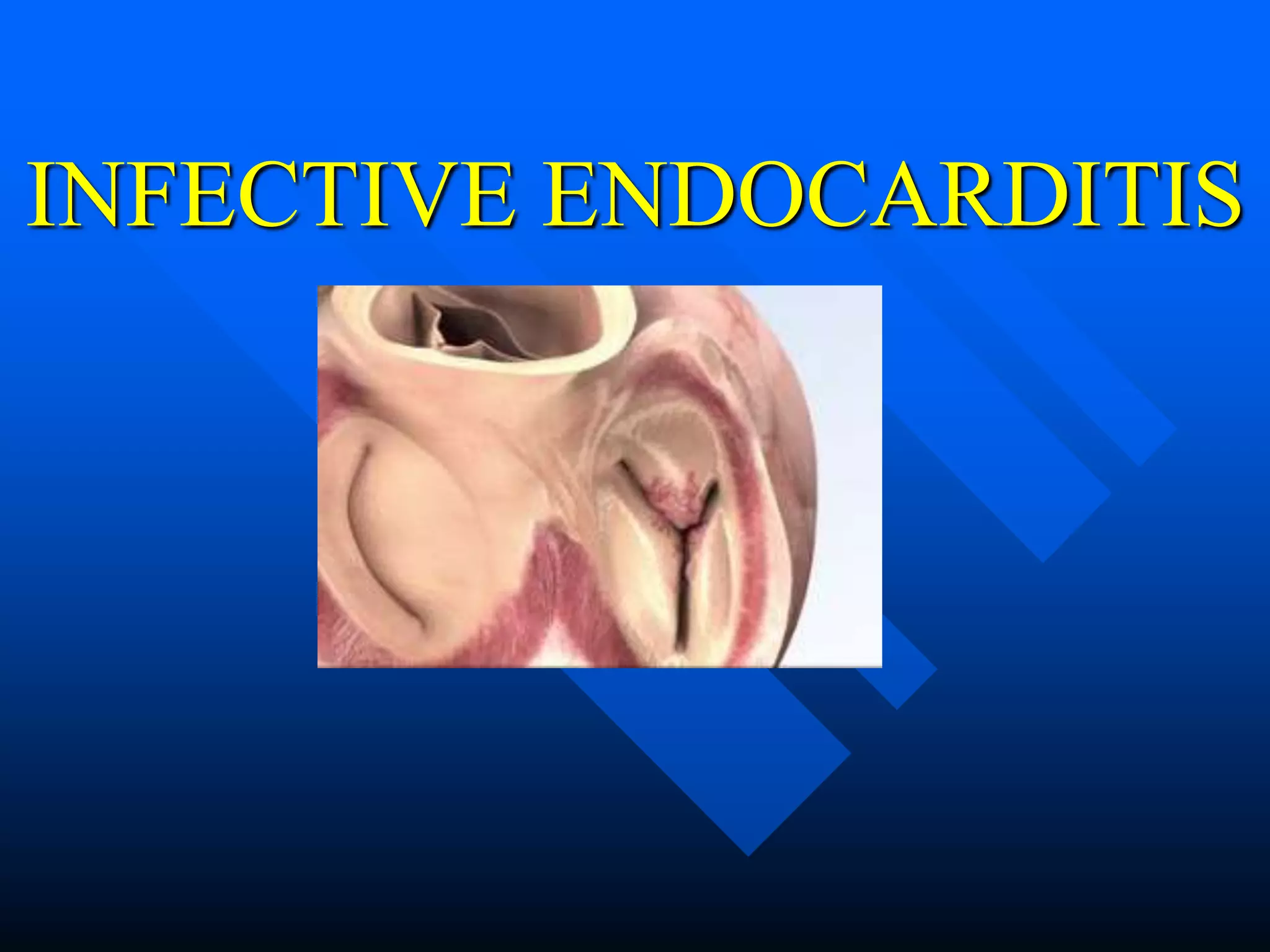 Infective endocarditis